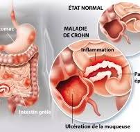 Photo maladie de Crohn